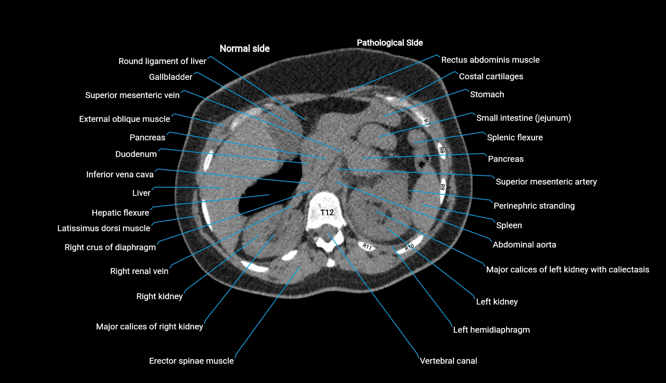 CT KUB axial cross sectional anatomy  radiology image -img-00201-00028.webp